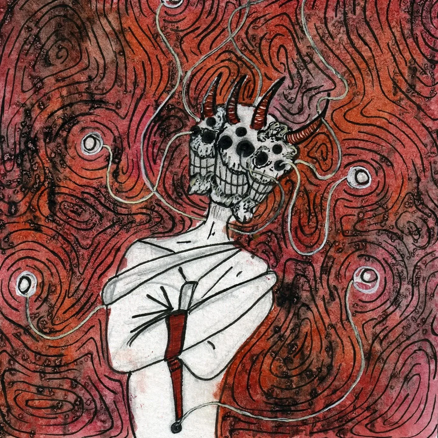 Glaucoma